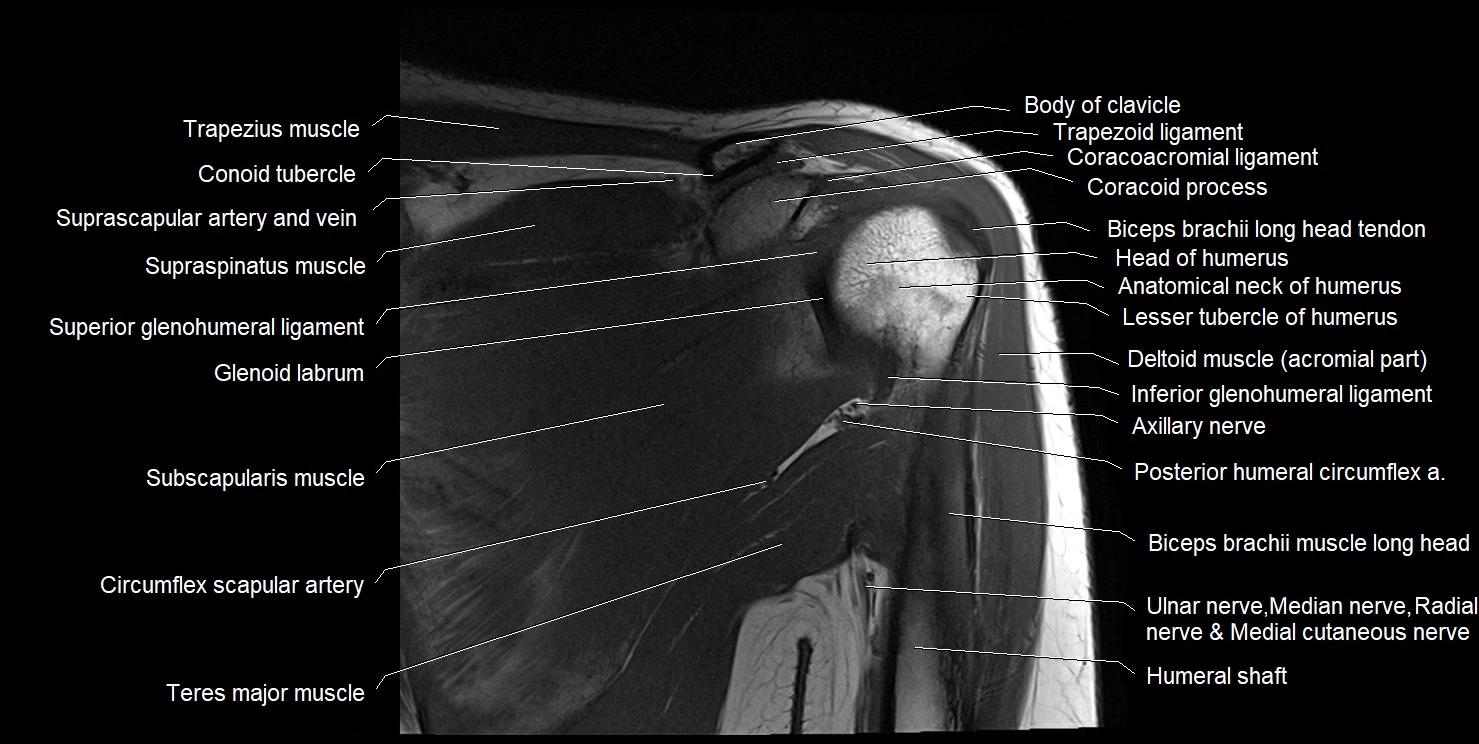 mri shoulder coronal cross sectional anatomy image 8.webp